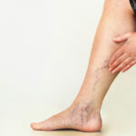 Varicose veins on the womans legs