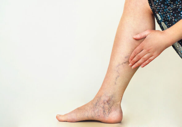 Varicose veins on the womans legs